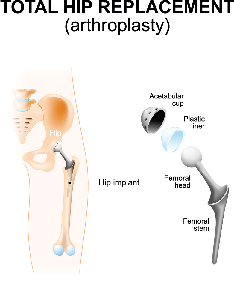 Hip Replacement Surgery (Total Hip Arthroplasty) - Schulze Orthopedics