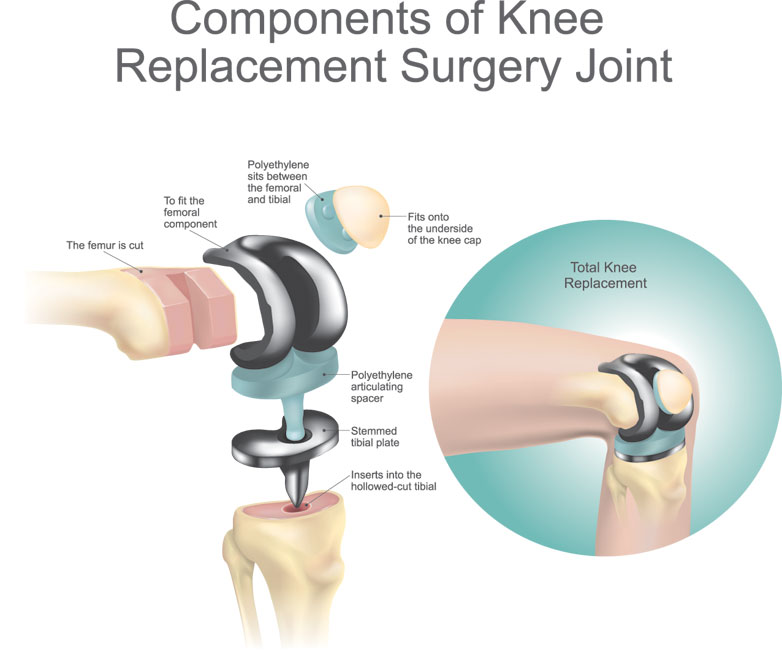 thesis of knee arthroplasty